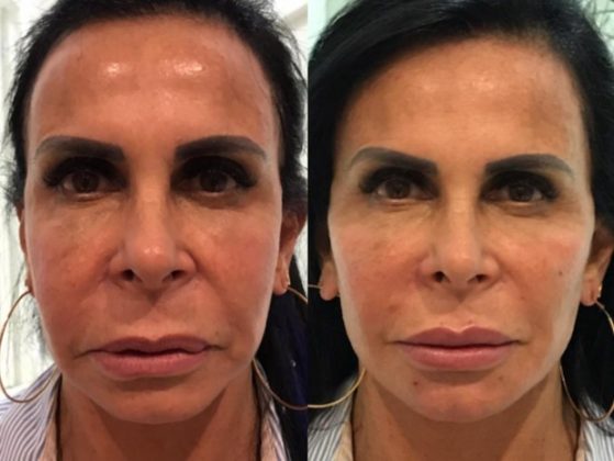 Harmonização Facial Preço e fotos do antes e depois