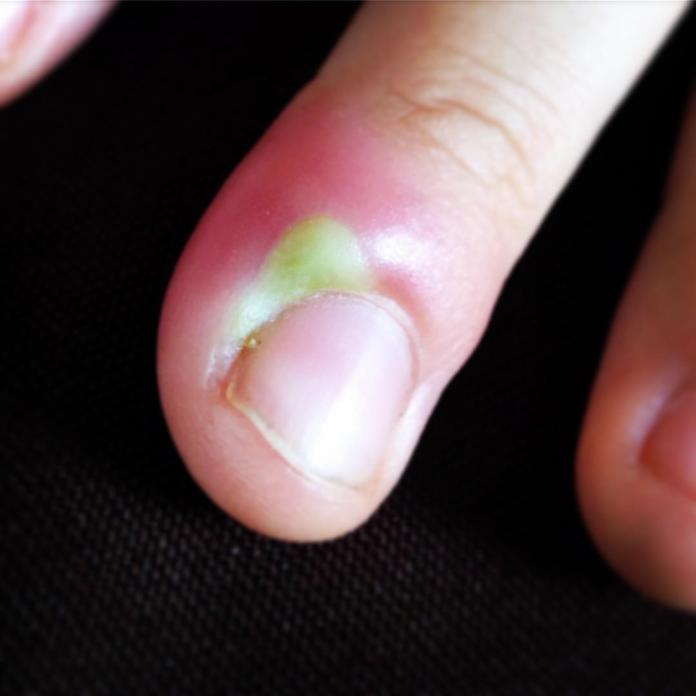 UNHEIRO Causas, Sintomas e Como Curar