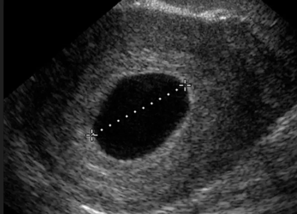 Мешочек в плодном яйце. Анэмбриония – пустое плодное яйцо. Неразвивающаяся беременность 7 недель УЗИ. УЗИ плодного яйца на 2-3 недели. 5 Недель беременности УЗИ плодное яйцо пустое.