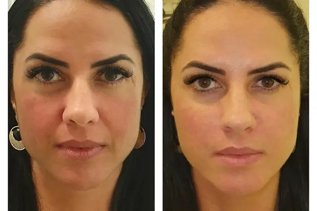antes e depois da harmonização facial de Graciele Lacerda