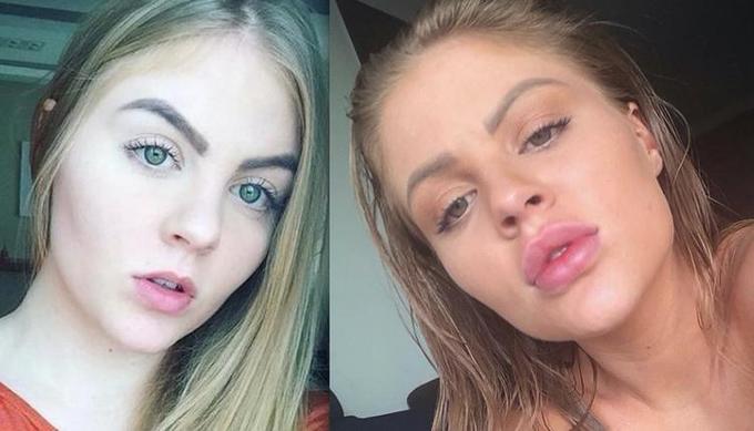 Luísa Sonza antes e depois da harmonização facial