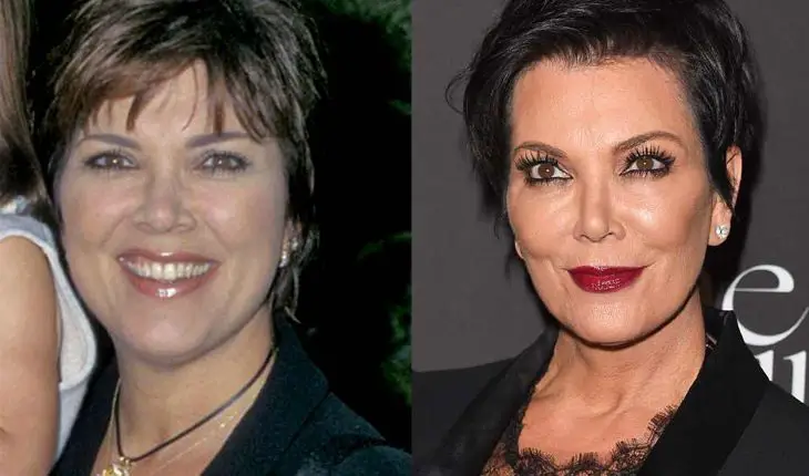 Kris Jenner antes e depois da harmonização facial