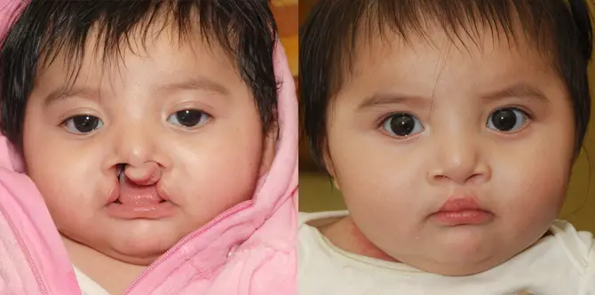 Cleft lip before and after