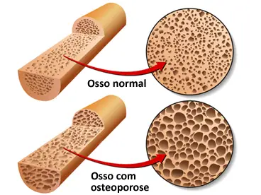 Alimentos que Ajudam a Prevenir a Osteoporose
