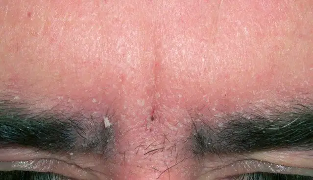 Dandruff on the Eyebrow Seborrheic Dermatitis: How to Treat 