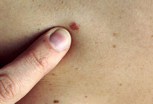 Câncer de pele: Sintomas Iniciais Fotos 
