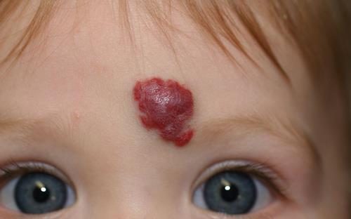 O que é Hemangioma