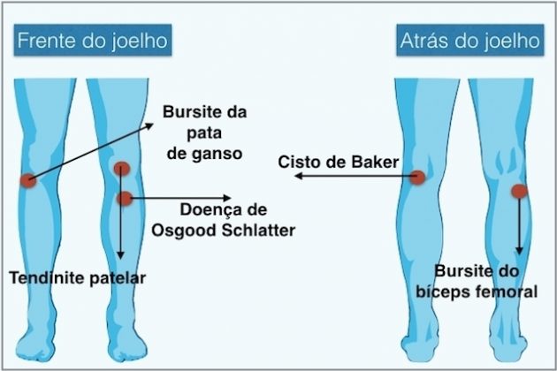 Dor No Joelho O Que Causa E Como Curar