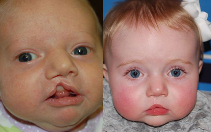 Cleft lip before and after