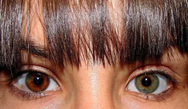 heterocromia