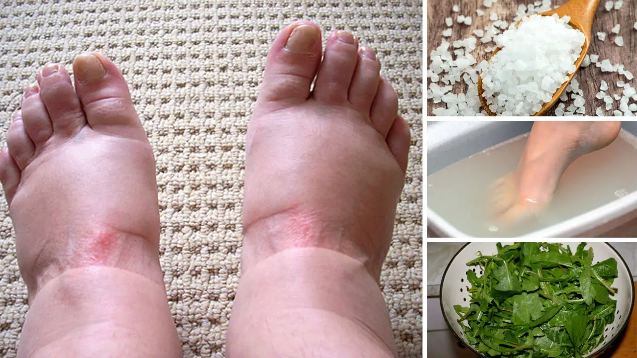Remédios caseiros para tratar os pés e tornozelos inchados
