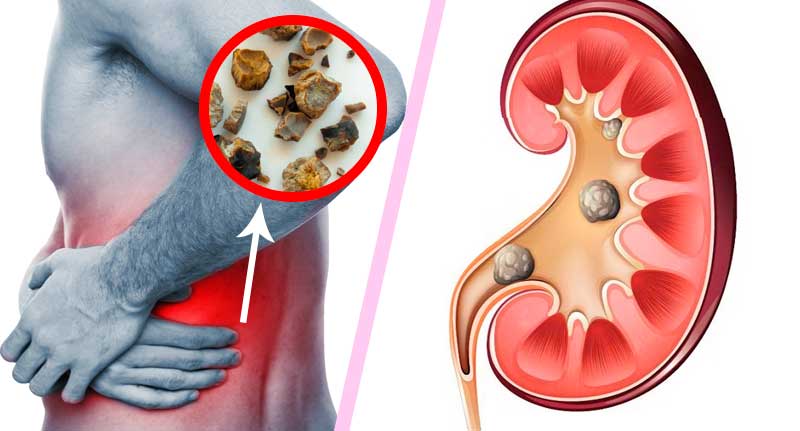 Como Prevenir Pedra Nos Rins