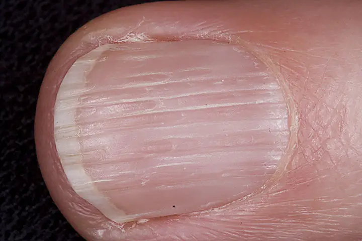 ridged nails